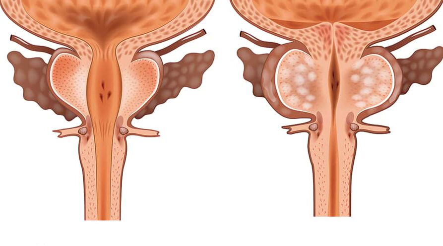 terve ja põletikulise adenoomi võrdlus
