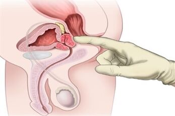 Eesnäärme massaaž kroonilise prostatiidi raviks